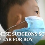 【動画】生まれつきの耳介奇形で耳が非常に小さい少年
