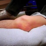 【動画】膝のお皿の骨が飛び出してしまった男性【膝蓋骨脱臼】