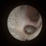 【動画】耳の穴のくぼみに溜まった巨大な耳垢を除去する