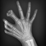 【画像】多指症の人々の手足のレントゲン写真（X線画像）