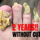 【動画】2年間伸ばし続けてボロボロになっている足の爪をパッキンパッキン取り除いていく爽快動画