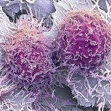 【閲覧注意】世にも美しい癌細胞画像２【ぶつぶつ】
