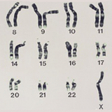染色体異常と減数分裂－ダウン症候群・ネコ鳴き症候群－