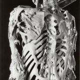 【画像】進行性骨化性線維異形成症（FOP）の患者の方々が提供した骨格画像