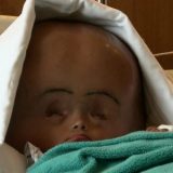 頭が通常の3倍に膨張してしまった生後18カ月の水頭症の赤ちゃん