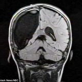 【Q＆A】大脳半球（大脳の半分）を切除するとどうなる？
