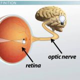 【Q＆A】視神経でも卒中が起こるの？