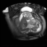 双子の兄弟が胎内にいる様子をMRIで覗き見してみた