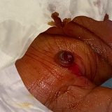 【閲覧注意】手のひらにできた肉芽腫をごっそりと切り除く映像