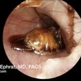 【閲覧注意】耳の中に入った虫をピンセットで取り除く映像