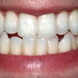 奥歯をくいしばる力はどれくらい？