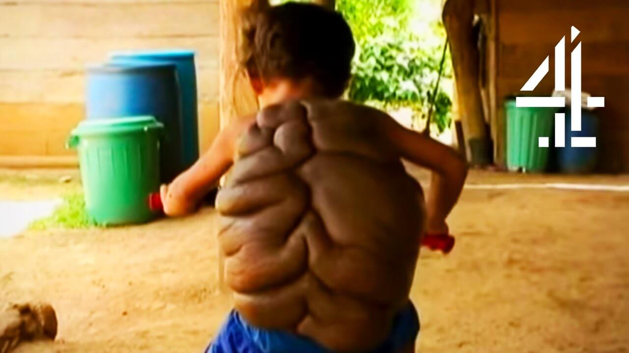 動画 背中にカメの甲羅のような巨大なホクロを背負う少年 バイオハックch