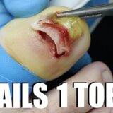 【超閲覧注意】１つの指に爪が2個生えて腫れているので根本から爪を除去する
