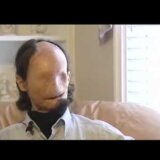 【動画】事故で目と鼻を失い顔が真っ平になった男性