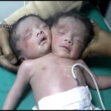 【動画】インドで生まれた頭が２つある赤ちゃん【結合双生児】