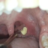 【閲覧注意】喉の奥から次々と膿栓（臭い玉）を取り除いていく映像