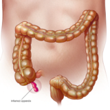 盲腸（虫垂炎）になると切られる虫垂には善玉菌を腸に送るという役割がある
